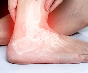 Sprains