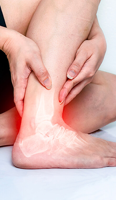 Sprains